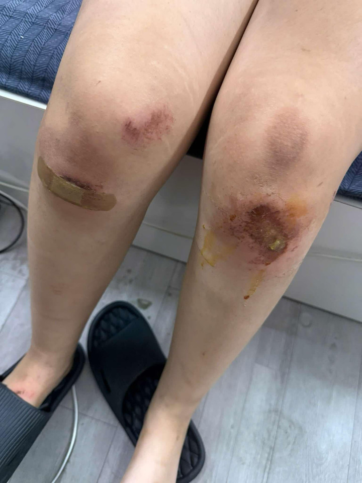 Hai chân cô gái trẻ bầm dập sau khi bị nhóm nam nữ đánh hội đồng.