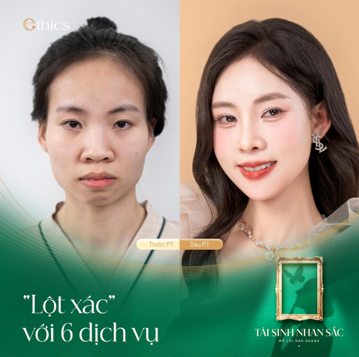 Cơ hội 'phá kén lột xác' với chi phí 0 đồng cùng Thẩm mỹ viện Ethics - 3