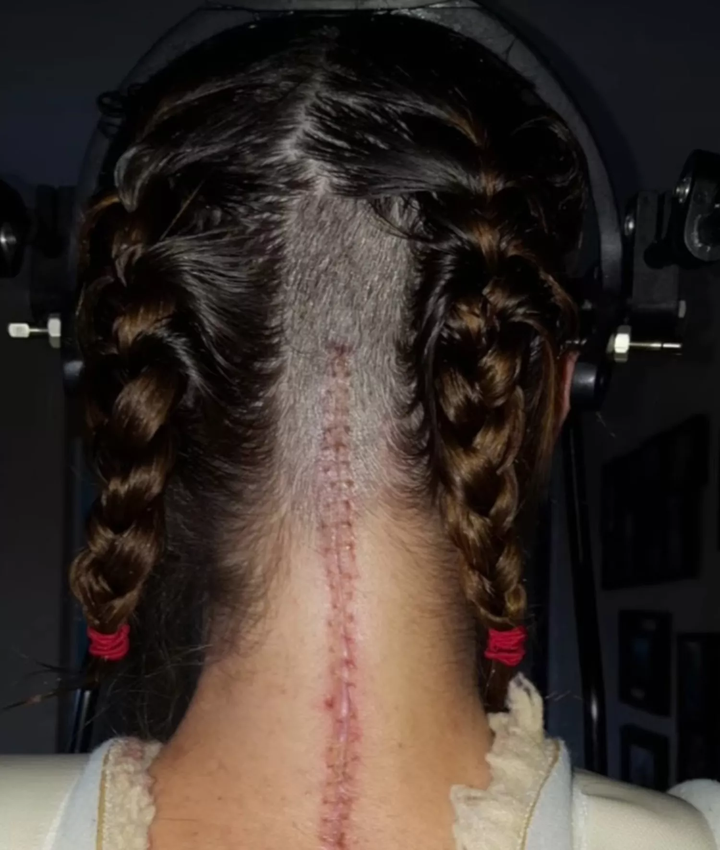 Đường khâu vết phẫu thuật để cố định xương sọ và cột sống của King.