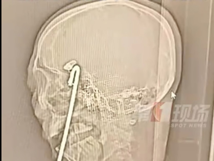 Phim X-quang cho thấy thanh sắt gần chạm vùng não quan trọng của Aqiang. (Ảnh: QQ.com)