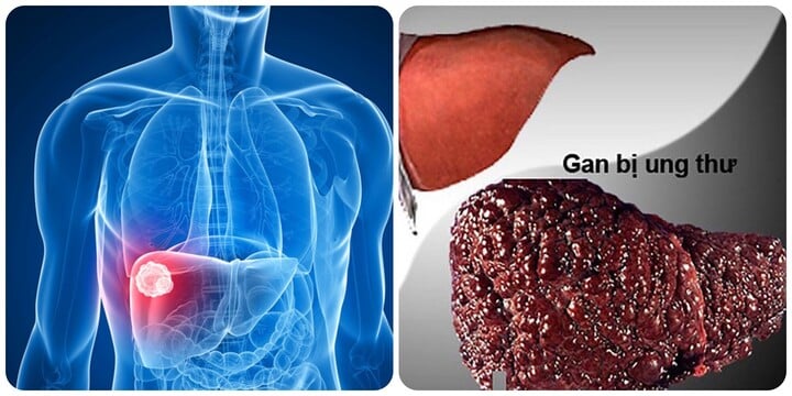 Ung thư gan là căn bệnh ung thư nguy hiểm gây tử vong hàng đầu