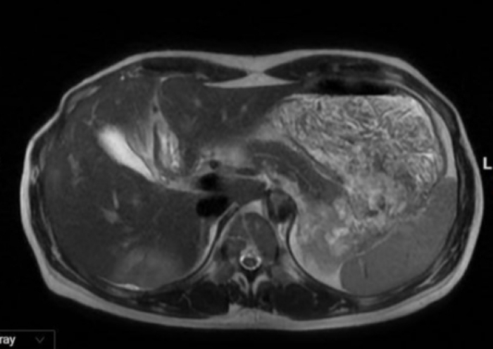 Thói quen đang "bào mòn" gan mỗi ngày mà bạn không biết