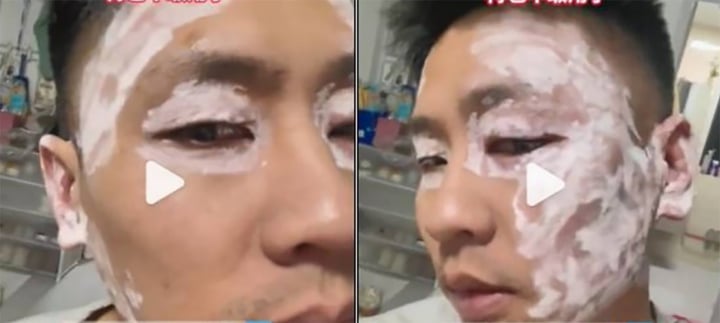 Sau nhiều ngày bôi thuốc, da mặt người đàn ông mới trở lại bình thường.
