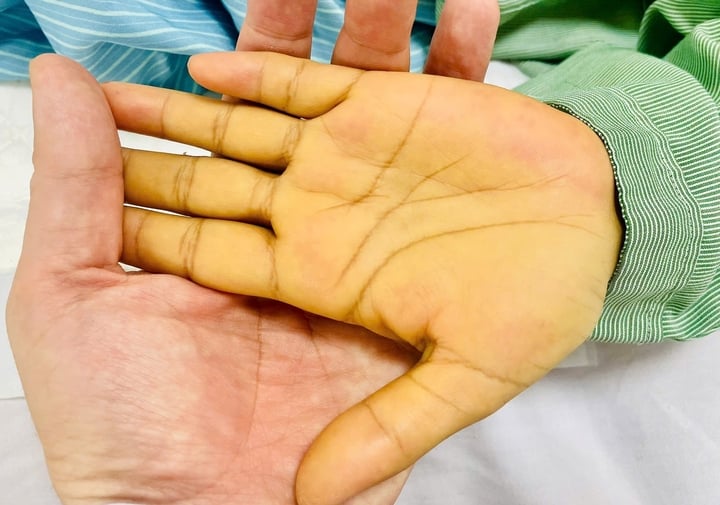 Một trong những biểu hiện đầu tiên thường gặp là vàng da. (Ảnh minh hoạ)