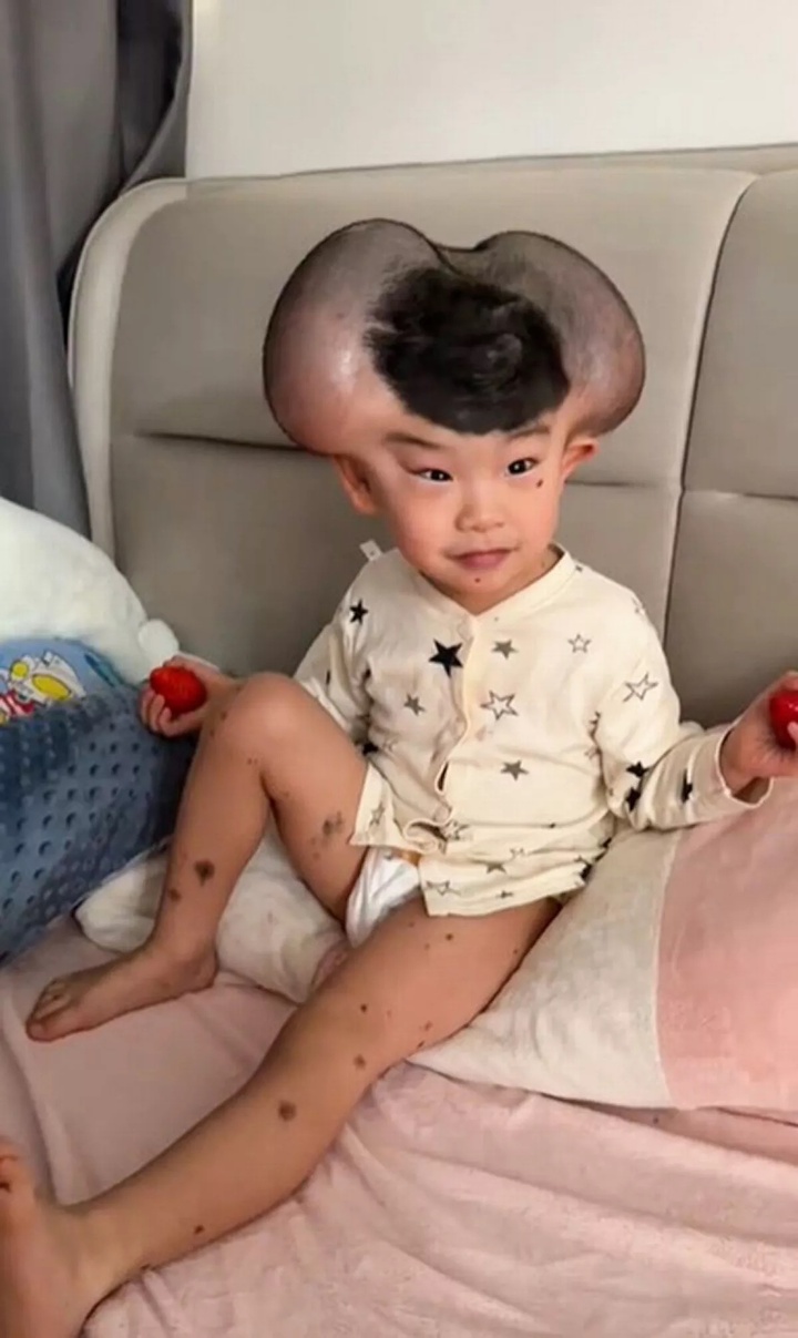 Qibao thường bị bạn bè trêu chọc vì trông giống chuột Mickey do hai khối u lớn trên đầu. (Ảnh: NX)