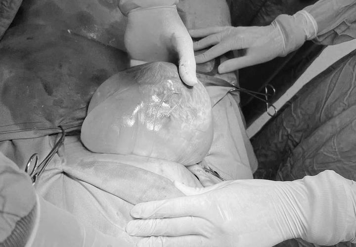 Ca sinh hiếm gặp, 80.000 trường hợp mới có một