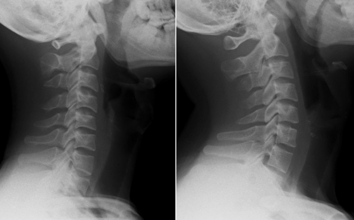 Nam thanh niên cột sống "thẳng như cây gậy" vì thói quen triệu người mắc