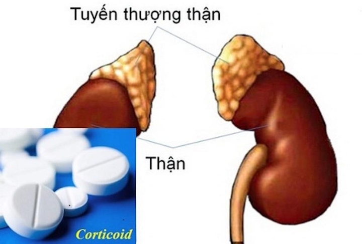 Suy thượng thận do thuốc Corticoid có chữa khỏi?