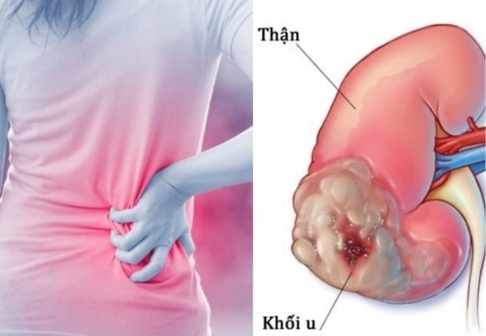 ung thư thận thường tiến triển âm thầm trong thời gian dài mà không biểu hiện triệu chứng rõ ràng. (Ảnh minh hoạ)