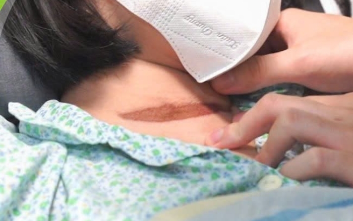 Bé gái ngừng tim, phù phổi vì bị cửa cuốn kẹp cổ