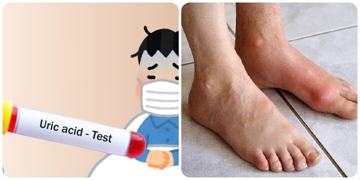 Axit uric là nguồn cơn gây ra nhiều bệnh nguy hiểm.