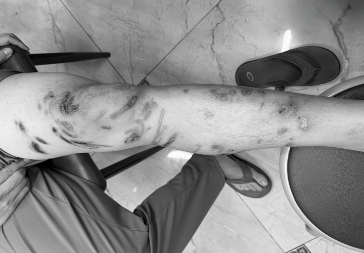 Tổn thương chằng chịt cơ thể do bị sứa chích khi tắm biển