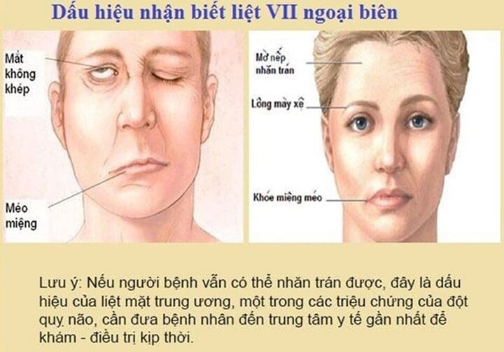 Phòng khám Lão Nhà Quê - ứng dụng YHCT trong điều trị liệt dây thần kinh số VII - 1