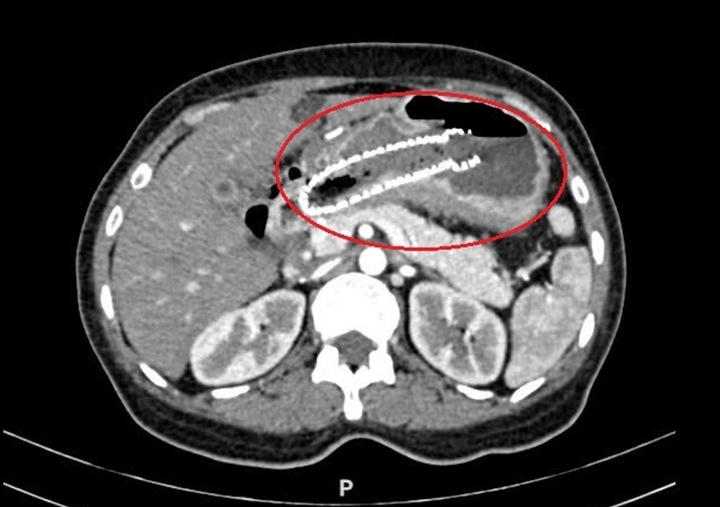 Bác sĩ Mỹ khuyên người phụ nữ về Việt Nam điều trị ung thư