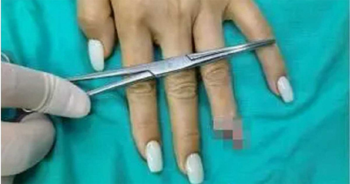 Ngón tay áp út bên trái của cô Lưu bị gãy. (Ảnh: Weibo)