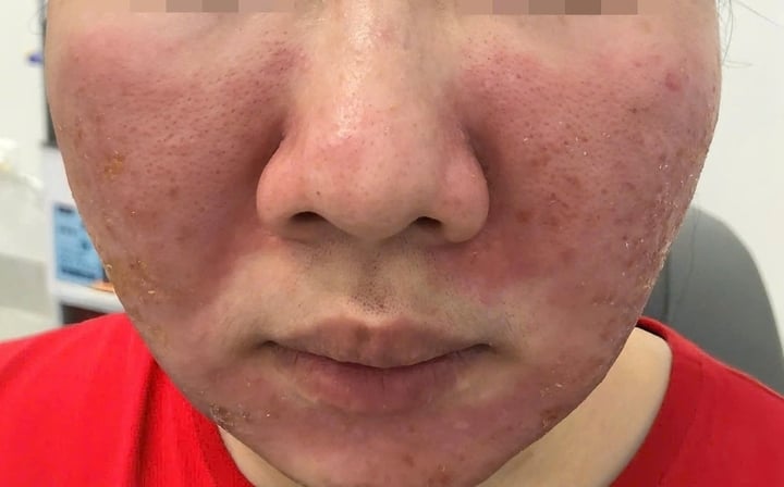 Cô gái đến viện khám đến viện khám trong tình trạng bỏng rát da mặt, nổi mẩn, bong tróc và sạm đen hai bên gò má. (Ảnh: BSCC)