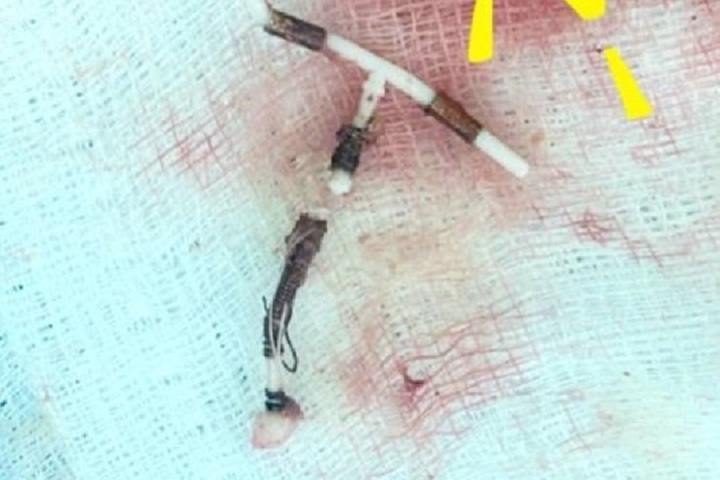 Phát hiện vòng tránh thai "đi lạc" trong ổ bụng người phụ nữ hơn 10 năm