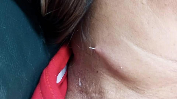 Chiếc xương cá màu trắng, sắc nhọn đâm từ trong cổ người phụ nữ ra ngoài.