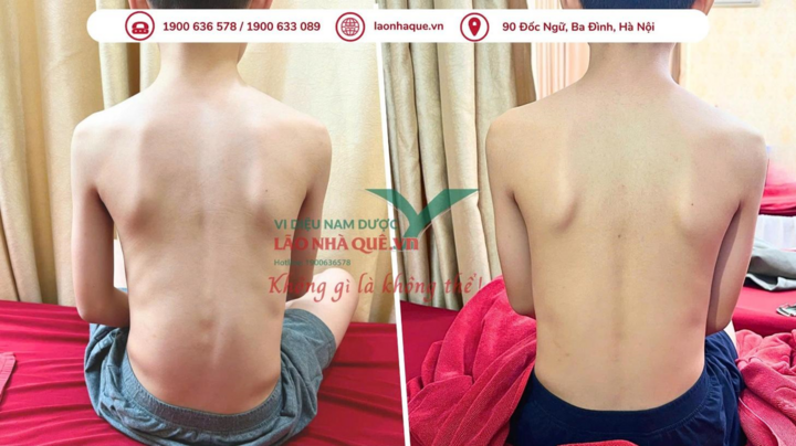 Hình ảnh bé trai 12 tuổi bị cong vẹo cột sống trước và sau trị liệu tại Phòng khám chuyên khoa YHCT Lão Nhà Quê – Vi diệu Nam Dược.