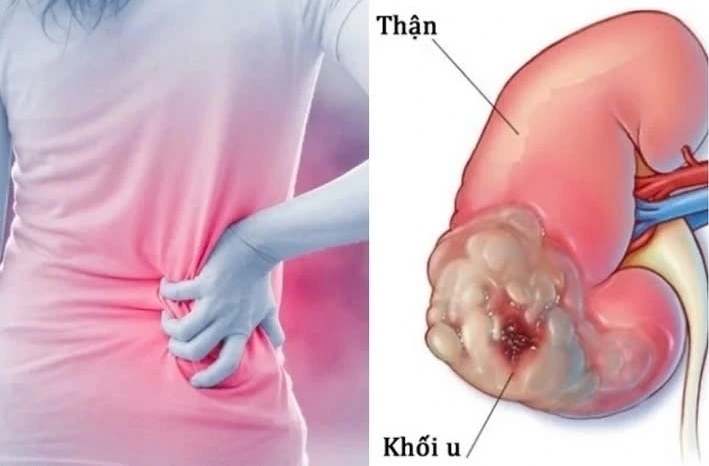 Ung thư thận là một trong những loại ung thư phổ biến ở nam giới Việt Nam. (Ảnh minh hoạ)