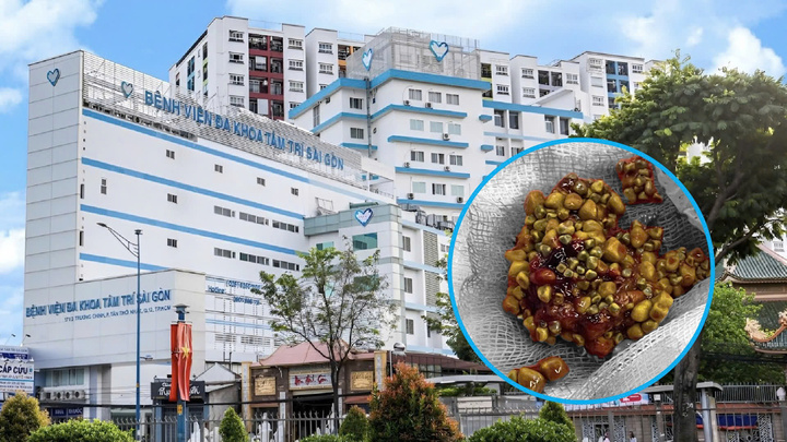Người đàn ông 60 tuổi ở Đồng Tháp có hàng trăm 'cục vàng'… trong túi mật - 1