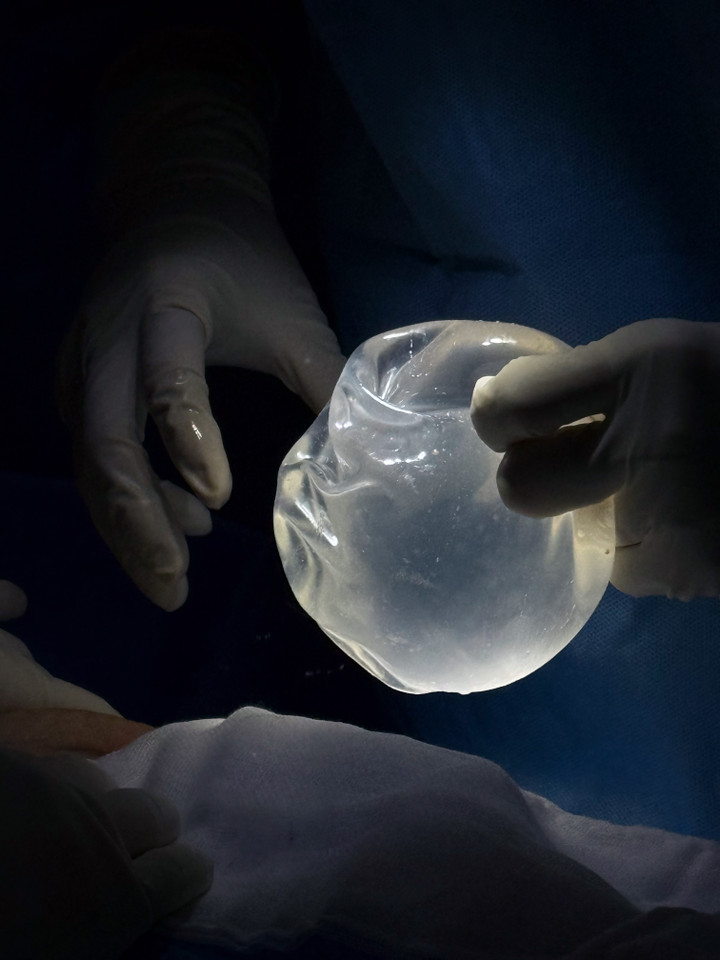 Tháo túi ngực, mê mask thanh quản - 2