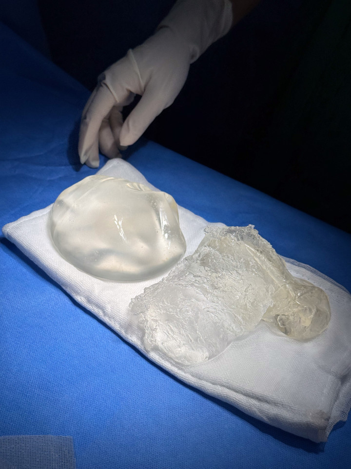 Tháo túi ngực, mê mask thanh quản - 3