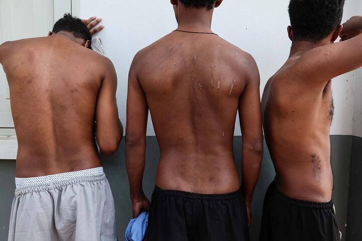 Một số nạn nhân buôn người với sẹo do bị chích điện và đánh đập. (Ảnh: Reuters)