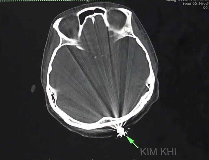 Hình ảnh tổn thương trên phim chụp. (Ảnh: BVCC)
