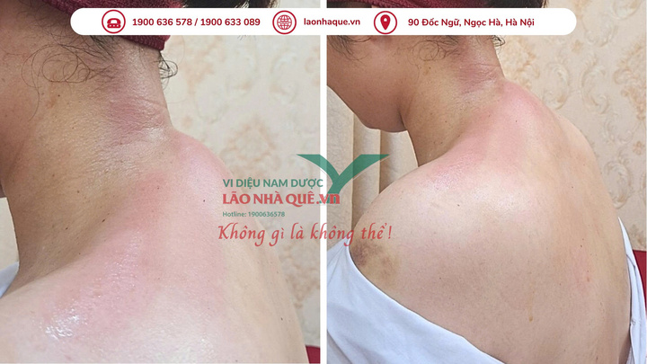 Hình ảnh vùng cổ vai gáy của một bệnh nhân thoái hóa đốt sống cổ lâu năm điều trị tại Phòng khám Chuyên khoa YHCT Lão Nhà Quê.