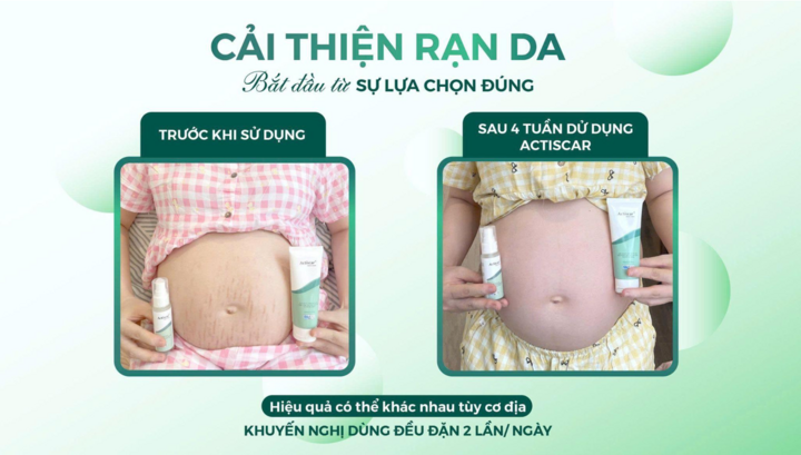 Minh chứng hiệu quả của Bộ đôi mờ rạn Actiscar qua trải nghiệm thực tế của người dùng.