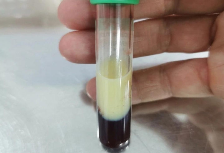 "Nhấp" vài lon bia mỗi tối, thanh niên suýt mất mạng vì mỡ máu tăng vọt