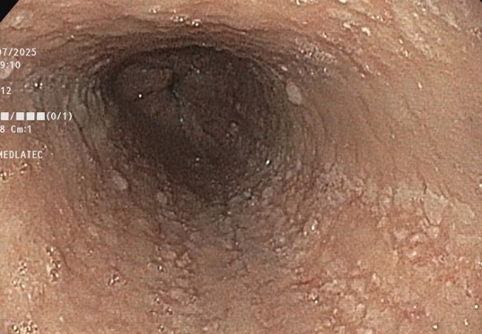 Người phụ nữ đi khám vì nuốt nghẹn, phát hiện 6 bệnh cùng lúc