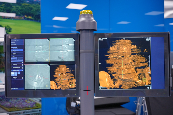 Hình ảnh 3D vùng cột sống trên máy C-arm 3D tích hợp AI.