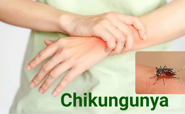 Nhóm người nguy cơ mắc bệnh Chikungunya
