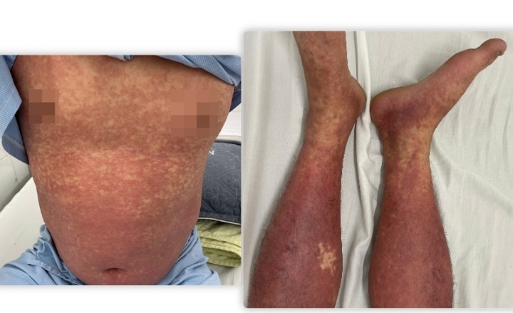 Hình ảnh phát ban toàn thân trên bệnh nhân dị ứng thuốc nặng do Phenylbutazone đang được điều trị tại Trung tâm Dị ứng & Miễn dịch lâm sàng.