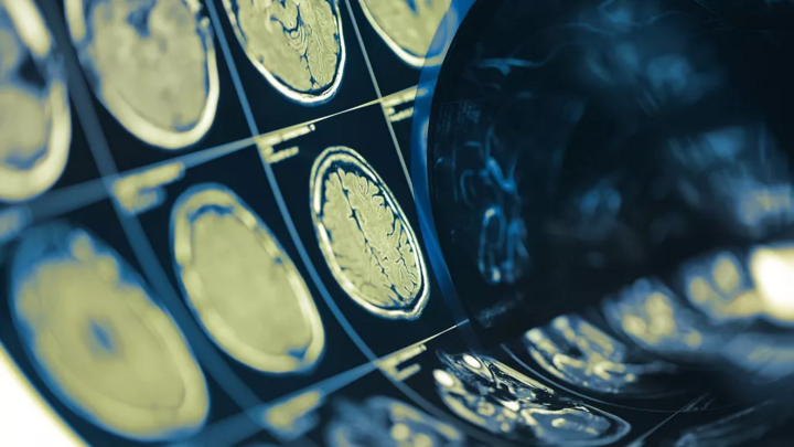 Công nghệ 17/8: Chip não giải mã suy nghĩ con người với độ chính xác 74%