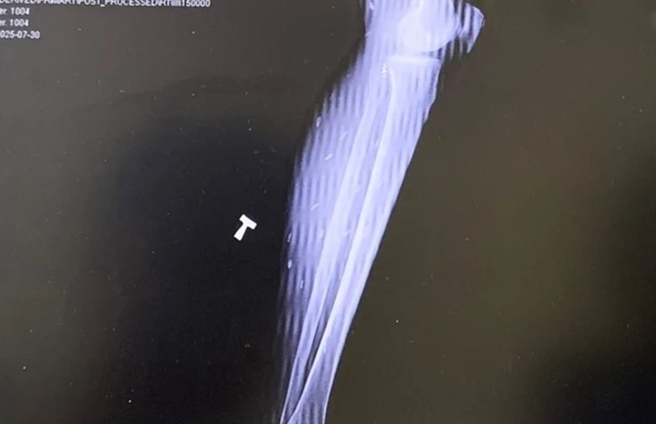 Sở thích ăn uống khiến người đàn ông "nuôi" ổ sán trong cơ thể