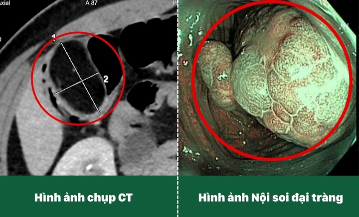 Hình ảnh khối u 5cm ở đại tràng góc gan.