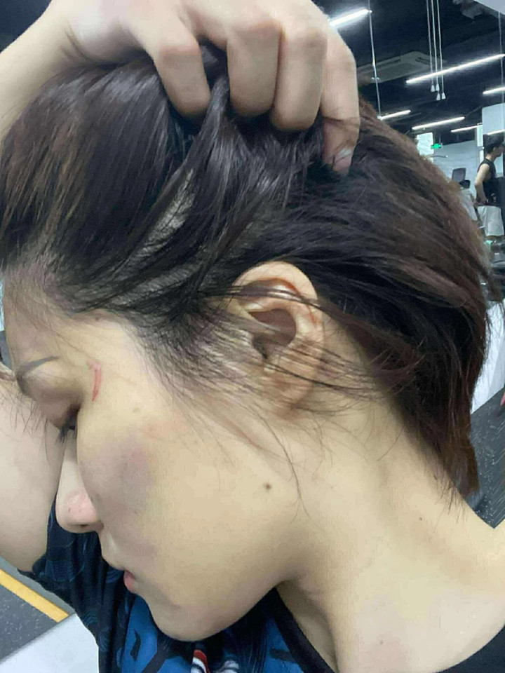 Hằng bị xây xước nhẹ ở mặt sau khi xô xát với nam thanh niên.