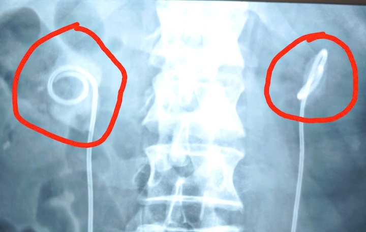 Suýt chết vì quên ống thông niệu quản trong cơ thể suốt 2 năm