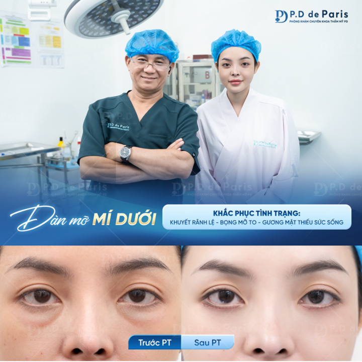 Dàn mỡ mí mắt - giải pháp khắc phục sụp mí, bọng mắt sau 30 tuổi ở PD De Paris - 2