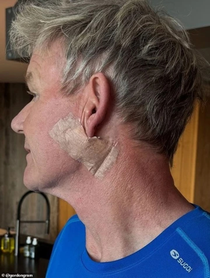Gordon Ramsay vừa trải qua ca phẫu thuật ung thư da. Ảnh: IGNV.