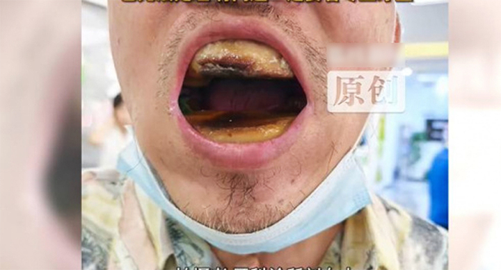 Hình ảnh hàm răng của người đàn ông. (Ảnh: Reproduced)