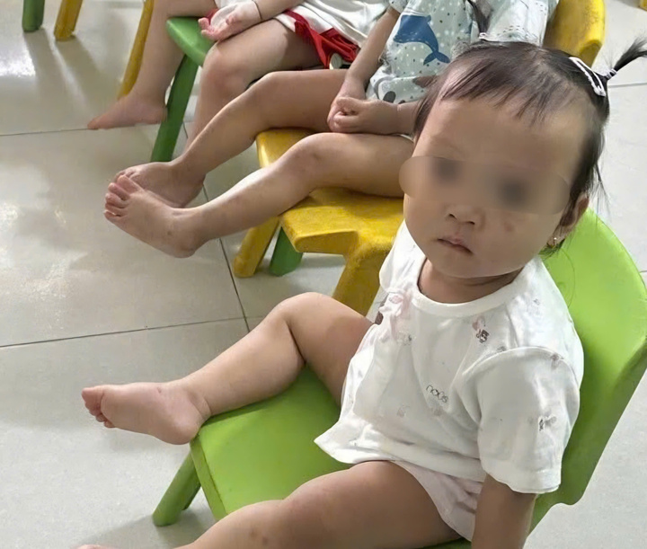 Tình trạng sức khỏe bé gái 1 tuổi bị bầm tím mặt khi gửi nhà trẻ ở Bắc Ninh