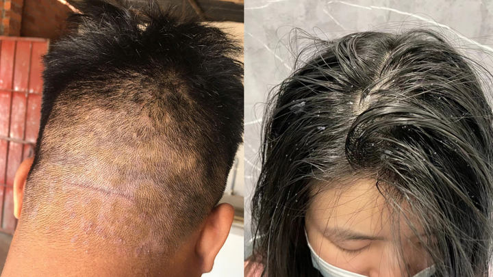 Các vấn đề gàu ngứa da đầu thường gặp.