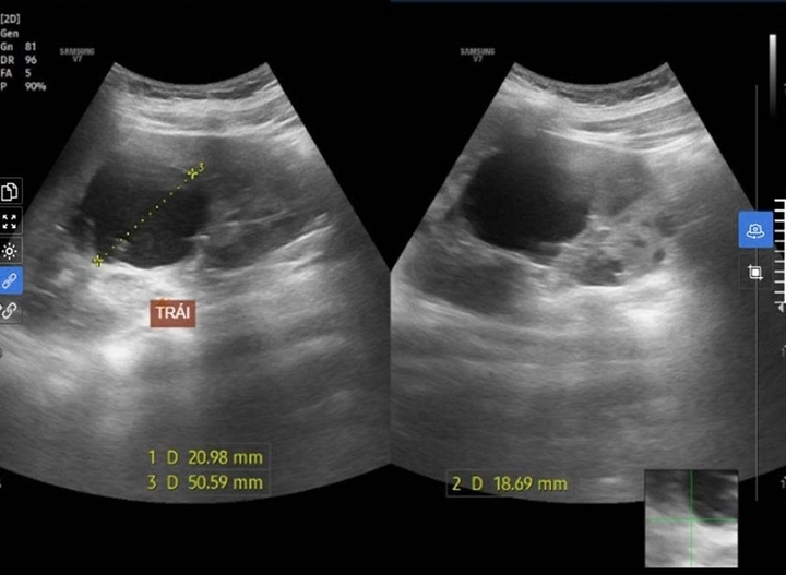 Nam sinh 15 tuổi khỏe mạnh đi khám phát hiện bị bệnh lý ba đời cùng mắc