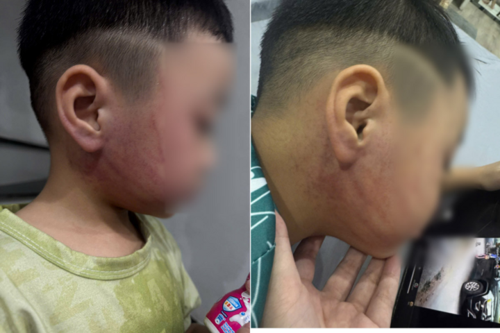 Hình ảnh cháu bé bị bầm tím. (Ảnh: GĐCC)