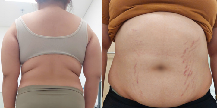 Bệnh nhi P.T.N.A tăng 20kg, vai thô, ụ mỡ gáy, vùng da bụng và đùi rạn đỏ.