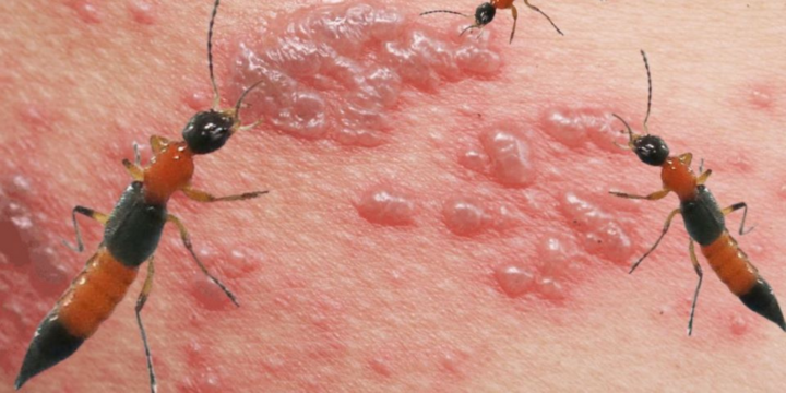 Bị kiến ba khoang đốt: Dấu hiệu, cách xử lý và thông tin cần biết